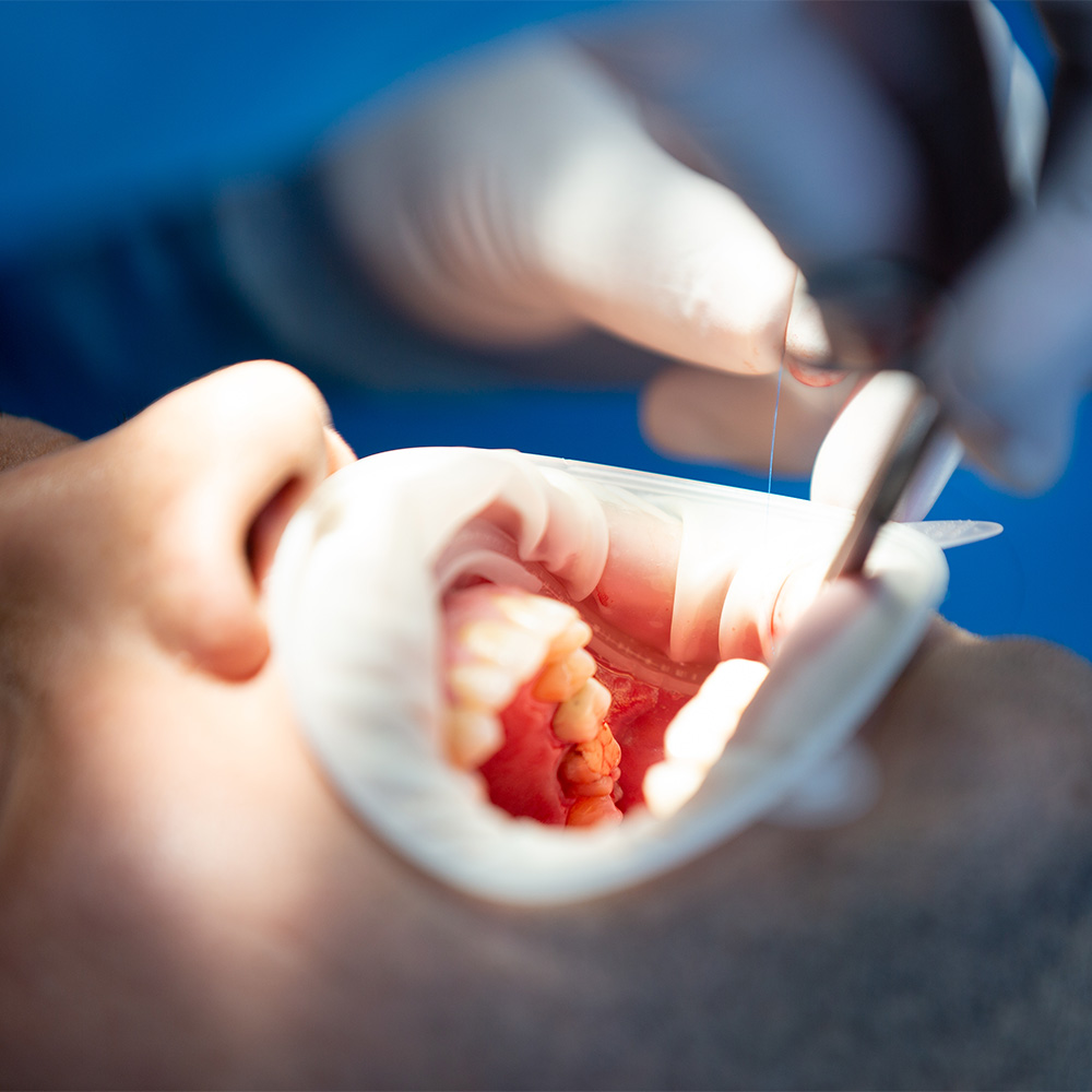 Tecnología de endodoncia rotatoria y localizadores de ápice de última generación en Cádiz.