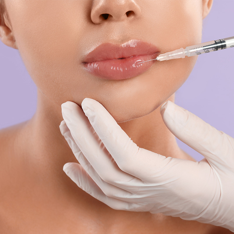 Aplicación de ácido hialurónico en labios para mejorar volumen, perfilado e hidratación.