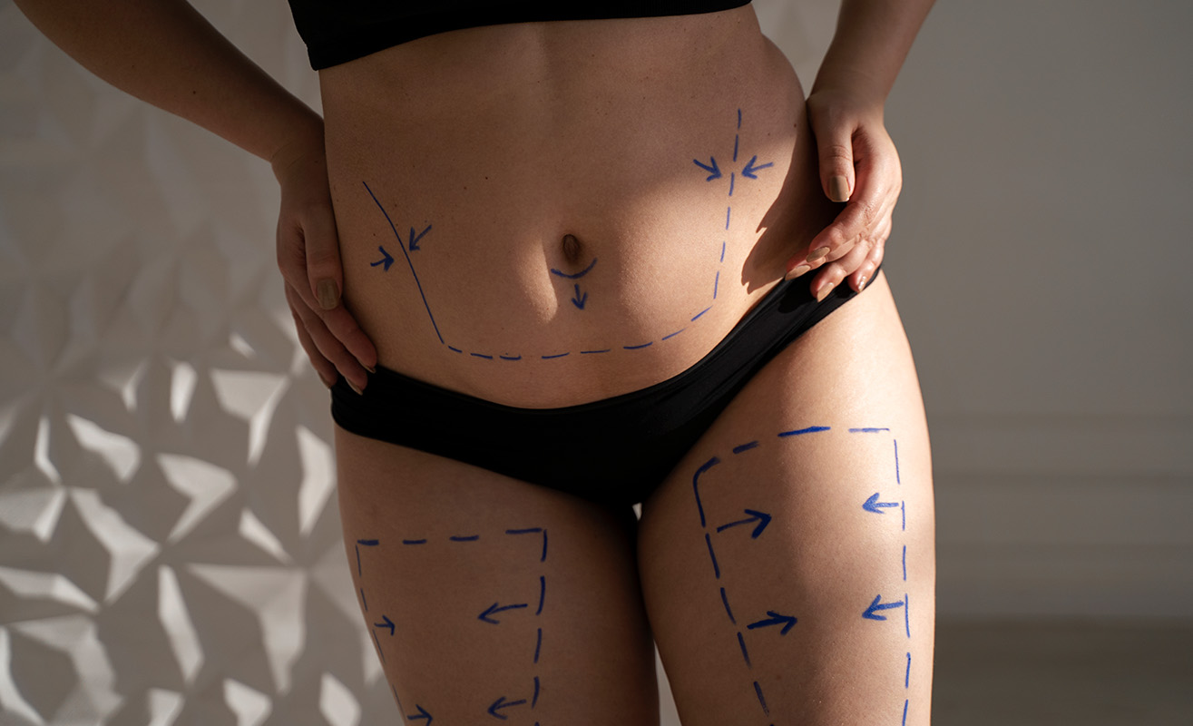 Paciente con marcaje quirúrgico en abdomen y piernas antes de una liposucción corporal.