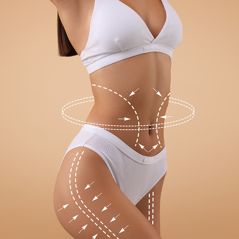 Mujer con líneas de remodelación corporal en abdomen, cintura y muslos para representar una liposucción 360.