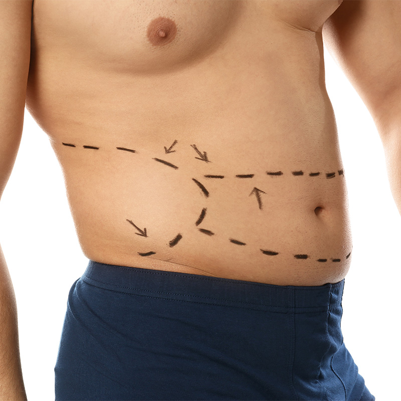 Hombre con marcaje quirúrgico en abdomen y flancos antes de una liposucción masculina.