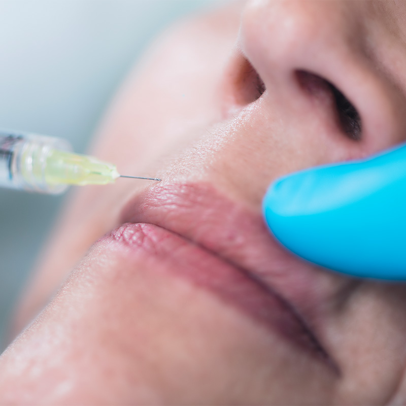 Aplicación de ácido hialurónico para perfilado de labios en clínica estética Cádiz.