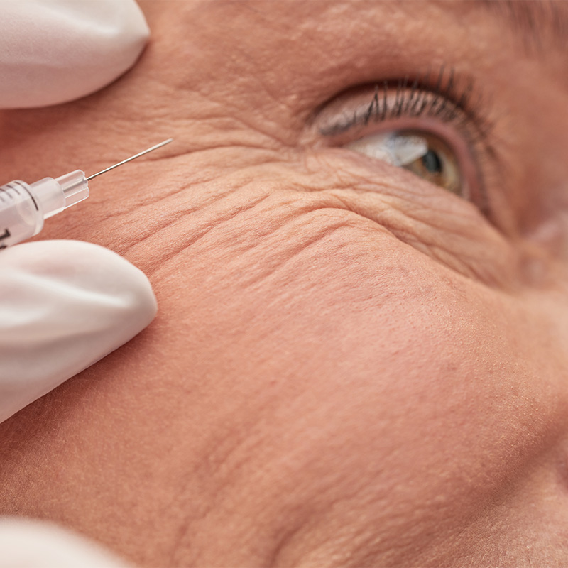 Tratamiento para eliminar arrugas y líneas de expresión en el contorno de ojos.