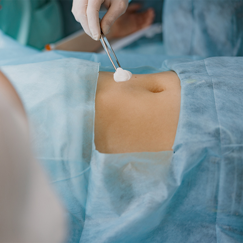 Marcación para tratamiento de liposucción en clínica de cirugía plástica Cádiz.