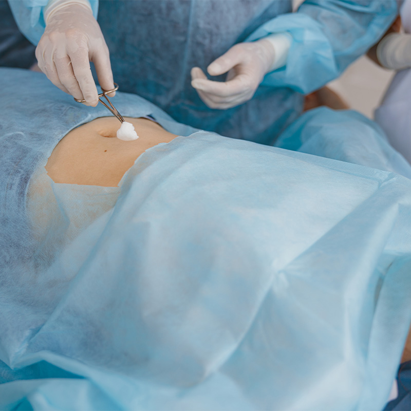 Abdomen de paciente en quirófano rodeado de telas azules quirúrgicas durante una operación.