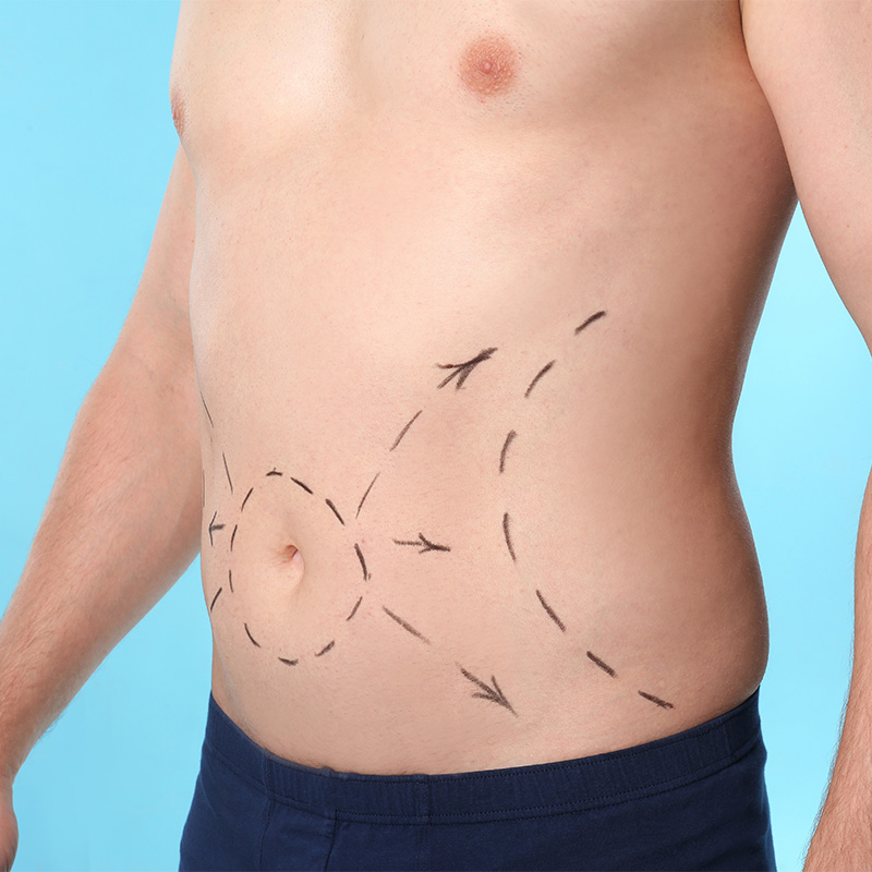 Cirujano plástico marcando zona abdominal para cirugía de abdominoplastia en Cádiz.