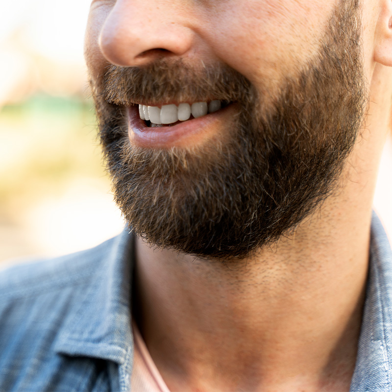 Resultado natural de injerto de barba en Cádiz tras 12 meses.
