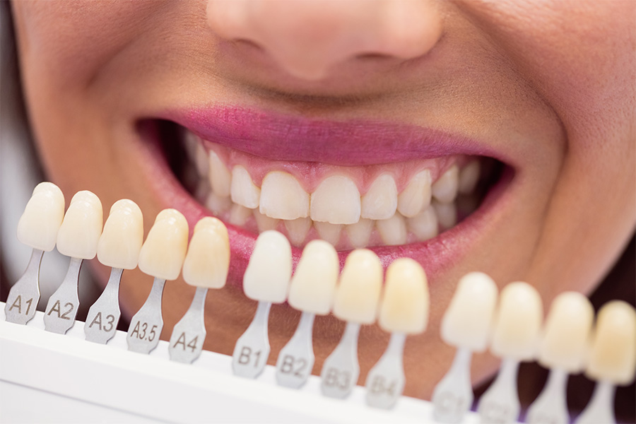 Uso de guía de tonalidades para elegir el color exacto de una prótesis dental en Cádiz.