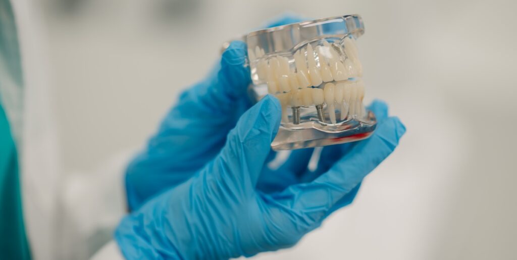 ejemplo de implante dental López Cano en Cádiz