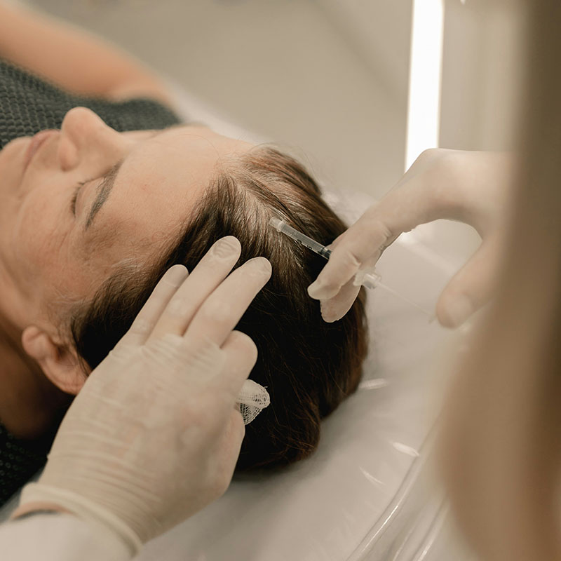 Vista superior de un tratamiento de mesoterapia capilar para combatir la calvicie y mejorar el grosor del pelo.