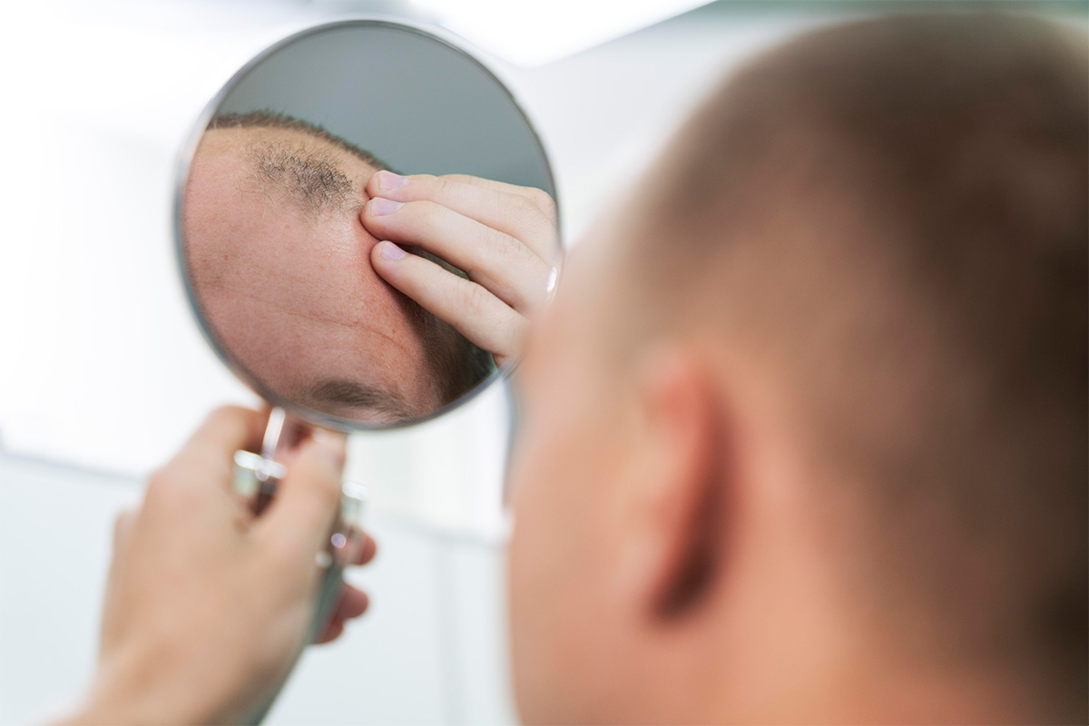 Hombre examinando su línea frontal antes de consultar cuánto cuesta un implante capilar.