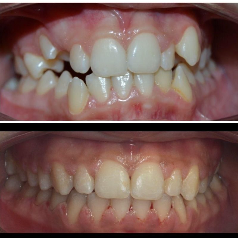 Ejemplo Ortodoncia de Clínica Dental Recoletas Salud López Cano