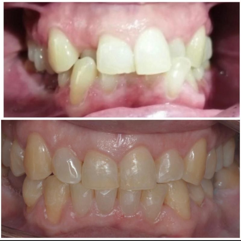 Ejemplo Ortodoncia de Clínica Dental Recoletas Salud López Cano