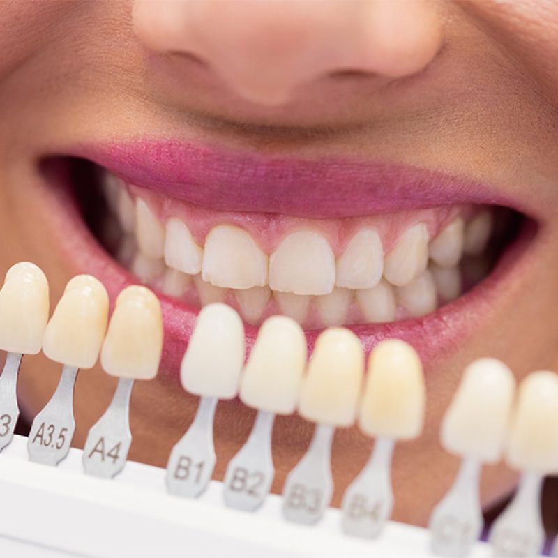 Uso de guía de tonalidades para elegir el color exacto de una prótesis dental en Cádiz.